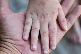 Alerta por virus Coxsackie en primaria de Bosques de San Sebastián 1 Virus