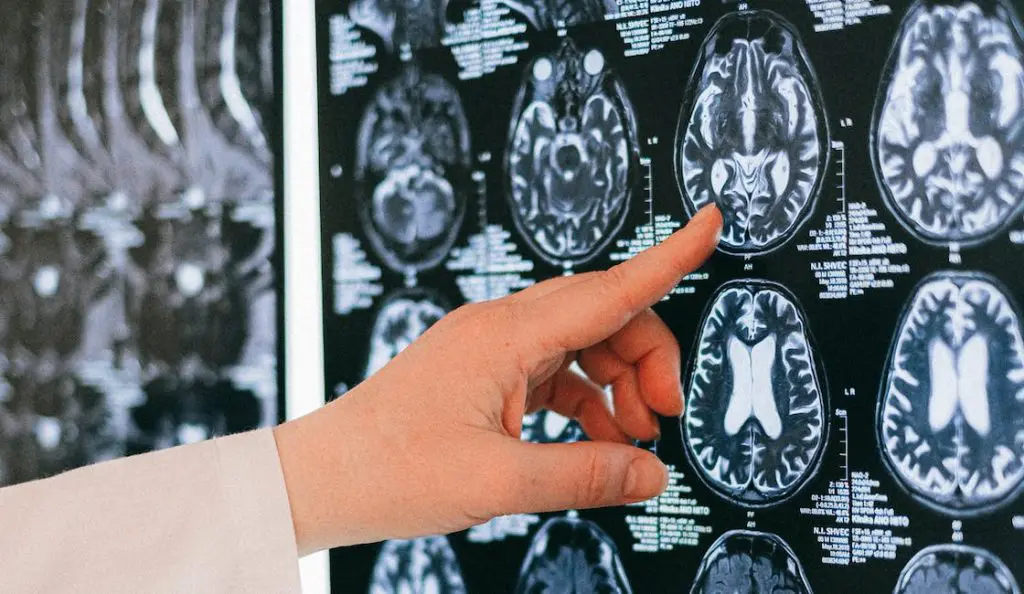 Nuevo tratamiento para el alcoholismo; la UNAM propone la estimulación magnética 2 Nuevo tratamiento para el alcoholismo la UNAM propone la estimulacion magnetica 3