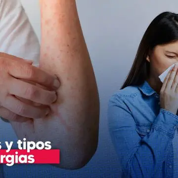 Día Internacional de las Alergias: causas, tipos más comunes y cómo prevenirlas