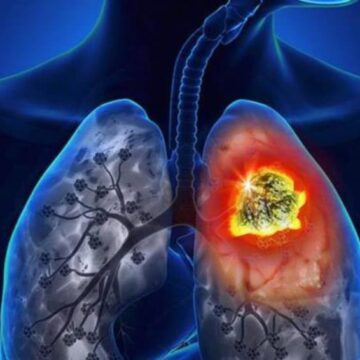 Cofepris da luz verde a nuevo tratamiento para cáncer de pulmón en México