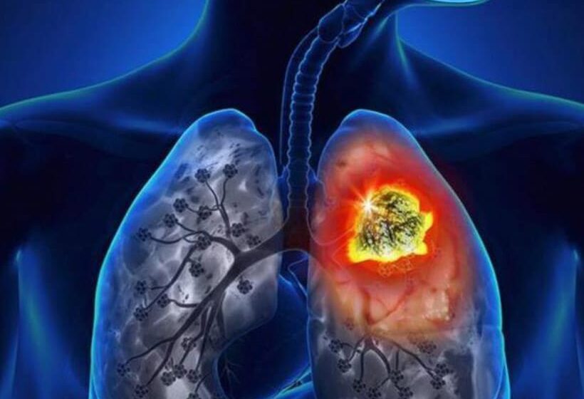 Cofepris da luz verde a nuevo tratamiento para cáncer de pulmón en México