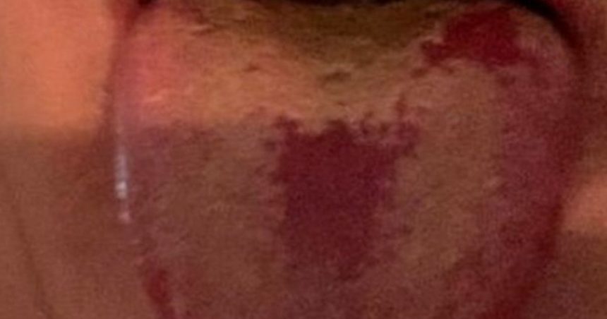 la-lengua-covid-la-imagen___I-61olQoN_1200x630__1 Nuevo síntoma de coronavirus en la lengua