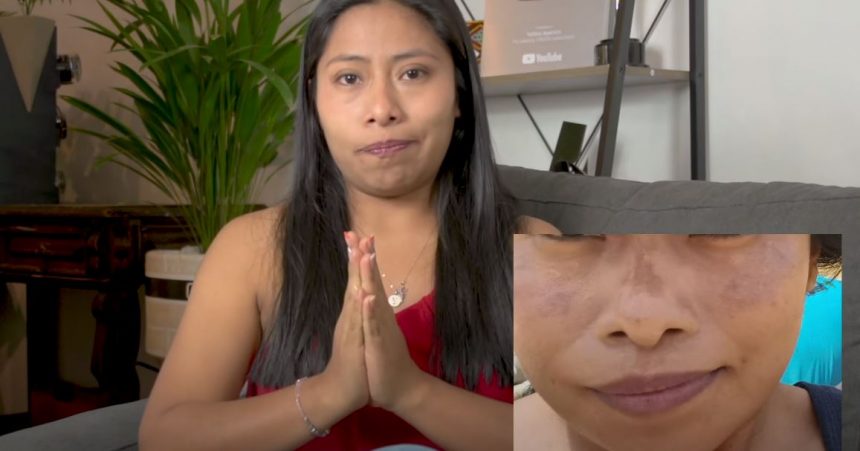 Yalitza Aparicio confiesa que padece condición cutánea después del tour de película Roma