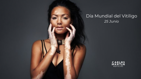 25 Junio Día Mundial del Vitiligo