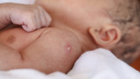 100 años de la vacuna contra tuberculosis
