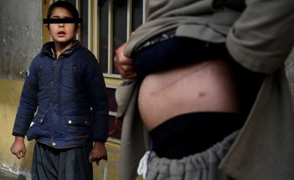 En Afganistan venden su riñon para darle comida a sus hijos