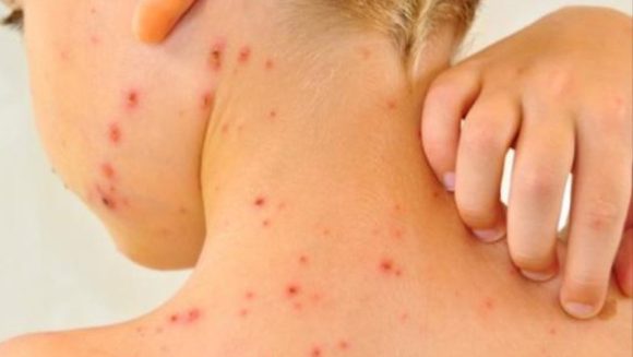 Secretaría de Salud desmiente supuesto caso de viruela del mono en México