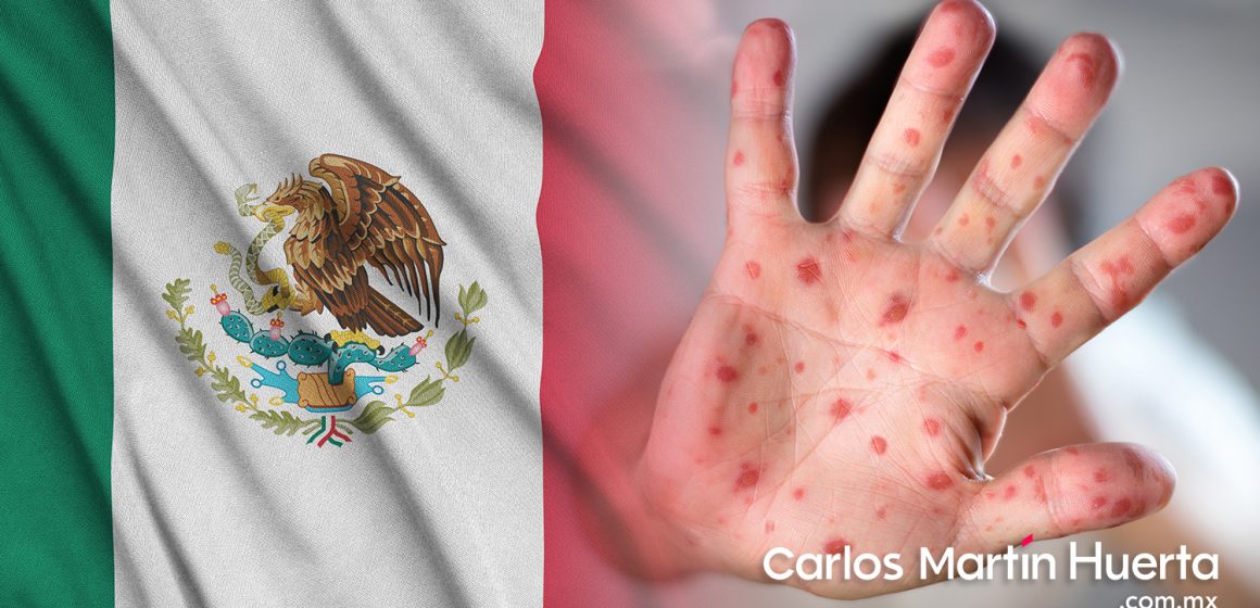 México confirma su primer caso de viruela del mono