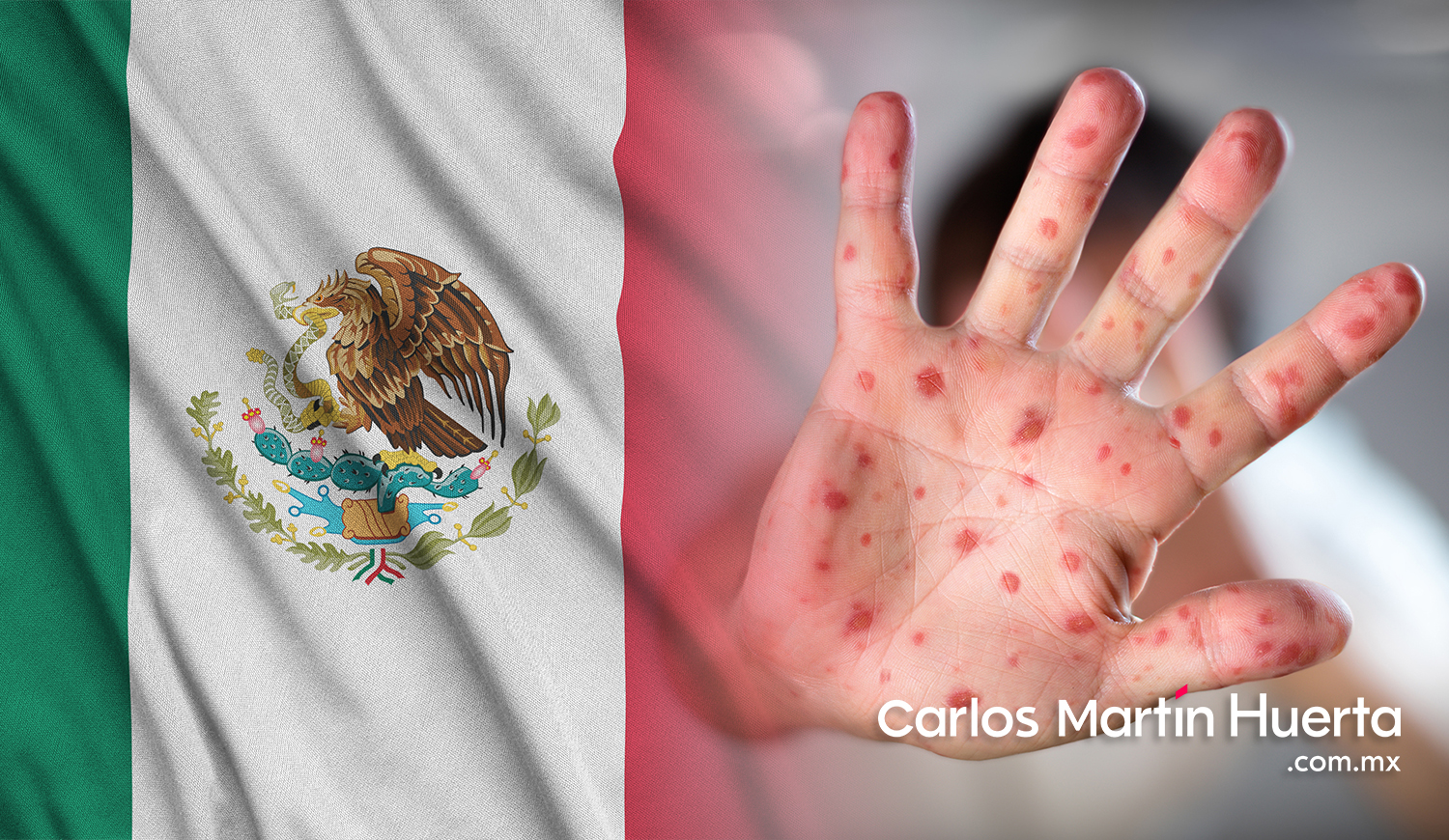 México confirma su primer caso de viruela del mono