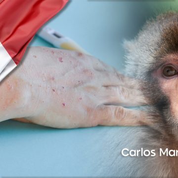 Conoce las formas de contagio, síntomas y tratamiento de la viruela del mono