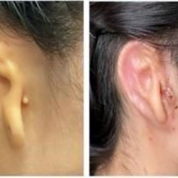 Implantan oreja humana impresa en 3D