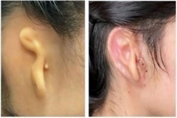 Implantan oreja humana impresa en 3D