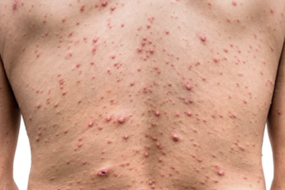 Detectan en Puerto Vallarta caso de viruela del mono en turista que se fugó de hospital