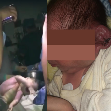 Por apagón en Mexicali, médicos alumbran cesárea con celulares y cortan oreja a bebé