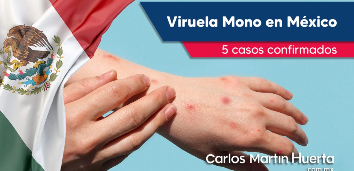 México tiene cinco casos confirmados de viruela del mono