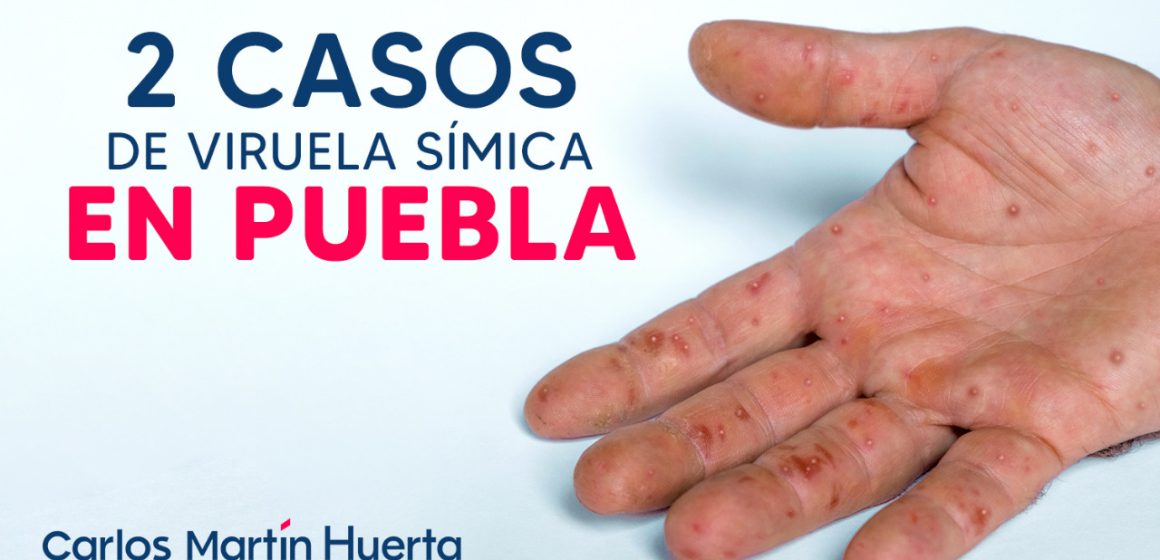 Puebla registra dos casos de viruela símica