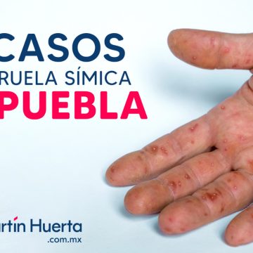 Puebla registra dos casos de viruela símica