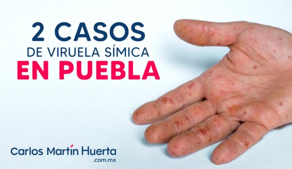 Puebla registra dos casos de viruela símica