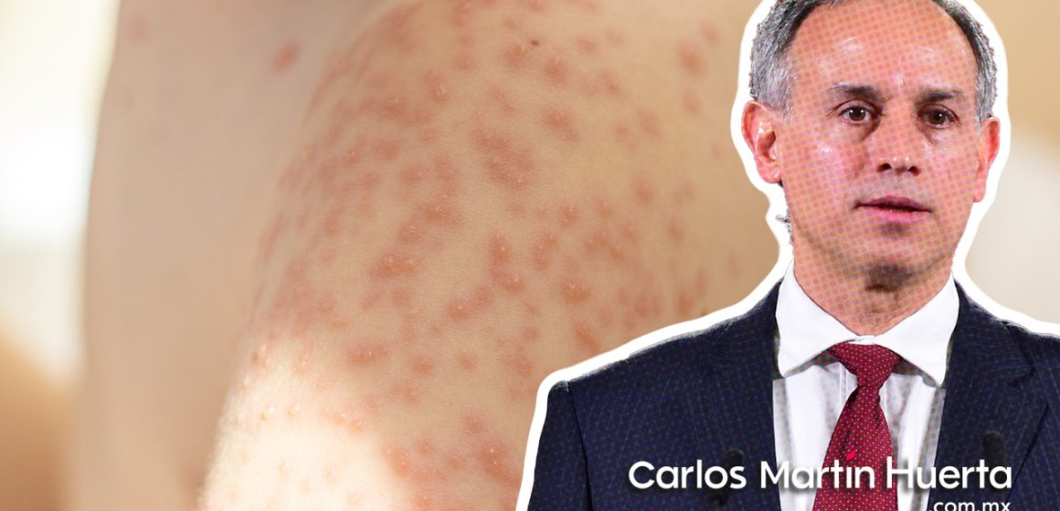 México ha registrado 60 casos de viruela símica