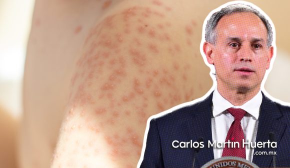 México ha registrado 60 casos de viruela símica