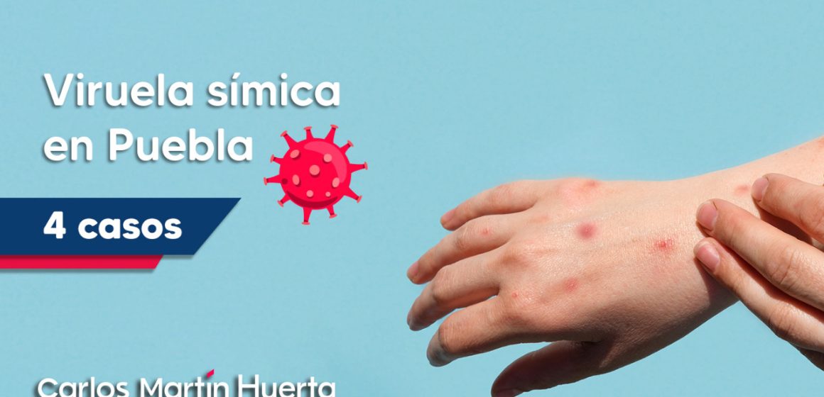 Cuatro casos confirmados de viruela del mono en Puebla
