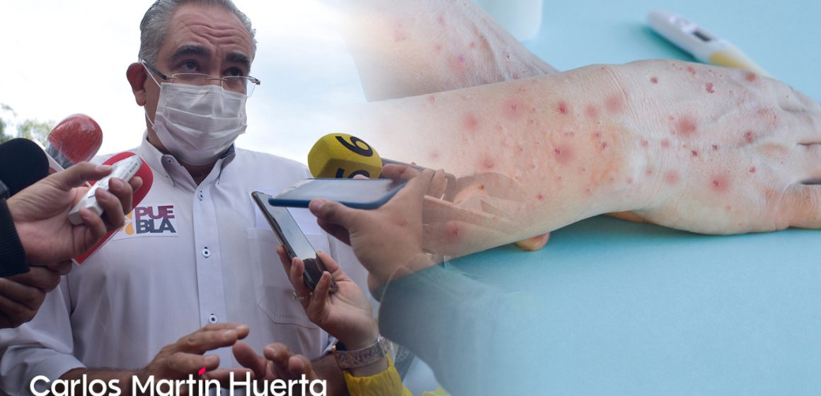 Analizan caso sospechoso de viruela símica en Puebla