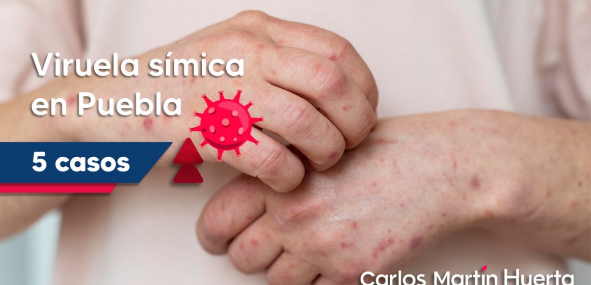 Salud reporta alta de cinco personas con viruela símica en Puebla