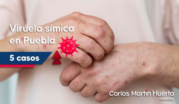 Viruela Símica Salud reporta alta de cinco personas con viruela símica en Puebla