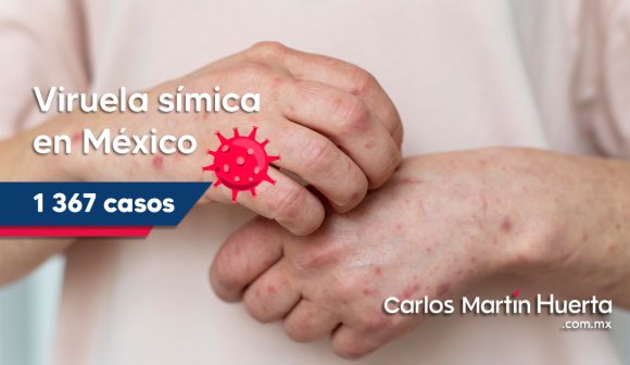 México suma mil 367 casos de viruela símica