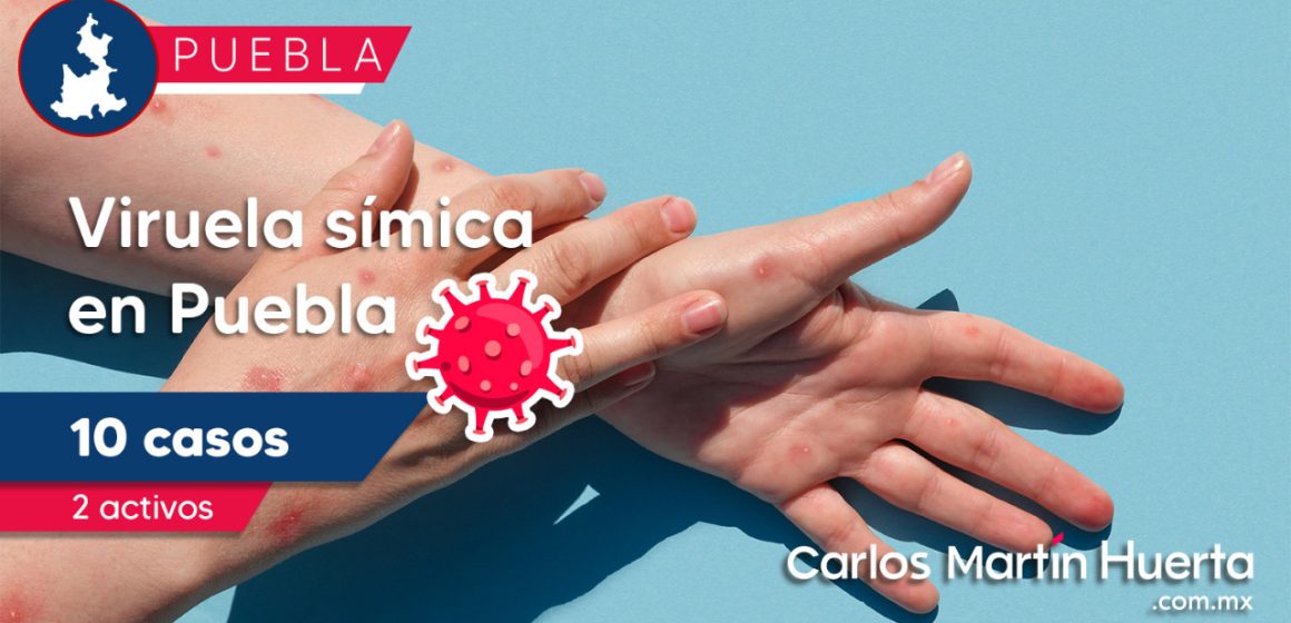 En Puebla se han registrado 10 casos de viruela símica