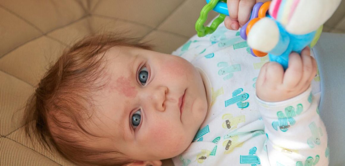 ¿Porqué nacen algunos bebés con una mancha en la frente?