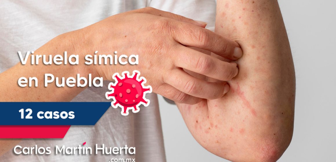 Puebla suma 12 casos de viruela símica