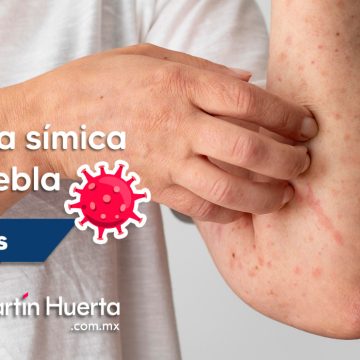 Puebla suma 12 casos de viruela símica