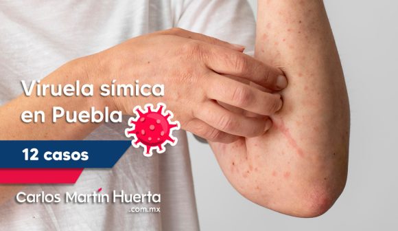 Puebla suma 12 casos de viruela símica