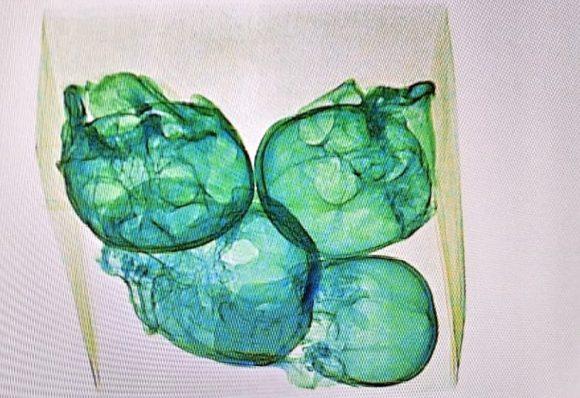 Cráneos GN (1) Detectan cráneos humanos en aeropuerto de Querétaro