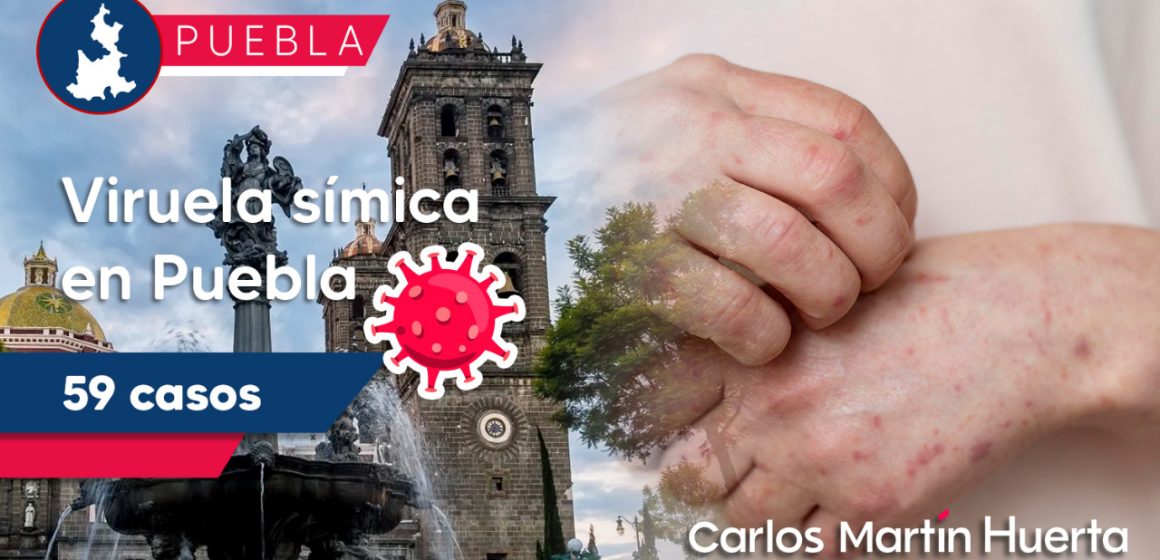 Puebla entre los primeros lugares por viruela símica
