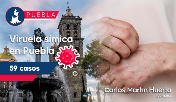 Viruela Símica - Puebla Puebla entre los primeros lugares por viruela símica