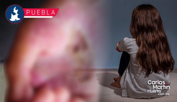 Padre le quema las manos a su hija en Amozoc; SEDIF interviene el caso