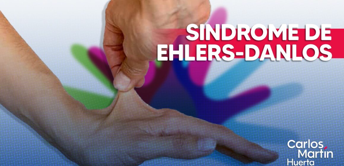 Síndrome de Ehlers-Danlos: La condición invisible que desafía los límites del cuerpo humano