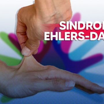 Síndrome de Ehlers-Danlos: La condición invisible que desafía los límites del cuerpo humano