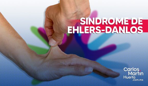 Síndrome de Ehlers-Danlos: La condición invisible que desafía los límites del cuerpo humano