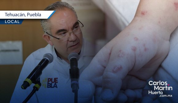 Salud confirma cuatro casos de coxsackie en primaria de Tehuacán