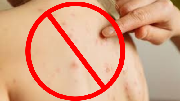 Puebla, sin casos de sarampión: Salud