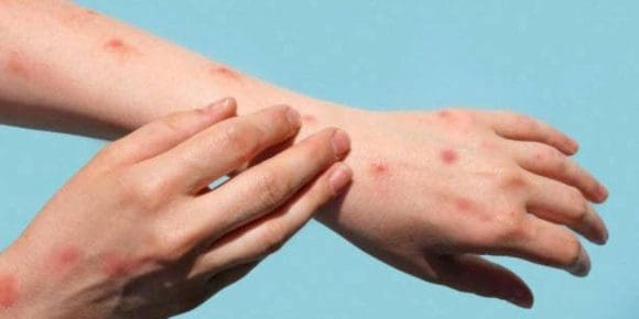 Descarta Salud casos en Puebla de viruela símica alertada por la OMS
