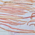 ¡Alerta en Chiapas! Extraen 142 lombrices a niño de 7 Años por obstrucción intestinal