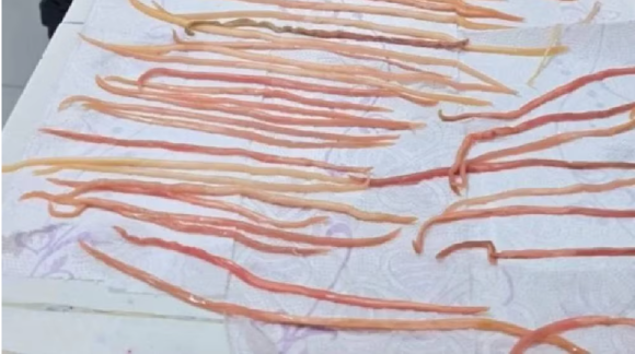 ¡Alerta en Chiapas! Extraen 142 lombrices a niño de 7 Años por obstrucción intestinal