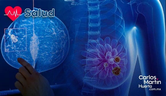 Nuevo avance contra el cáncer de mama: TIM-3, el talón de Aquiles de las células metastásicas