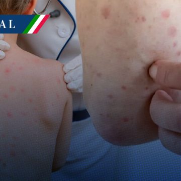 Sarampión en México: 95% concentrados en Chihuahua