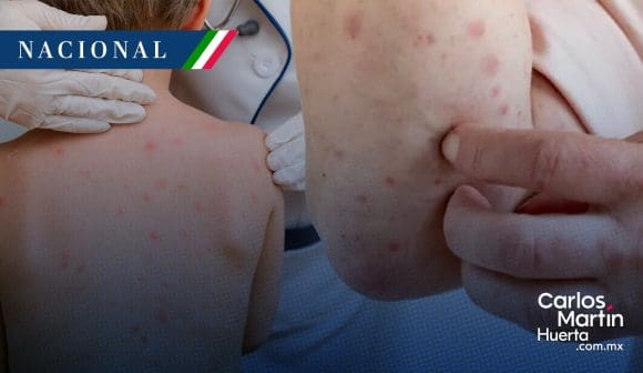 Sarampión en México: 95% concentrados en Chihuahua