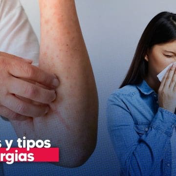 Día Internacional de las Alergias: causas, tipos más comunes y cómo prevenirlas